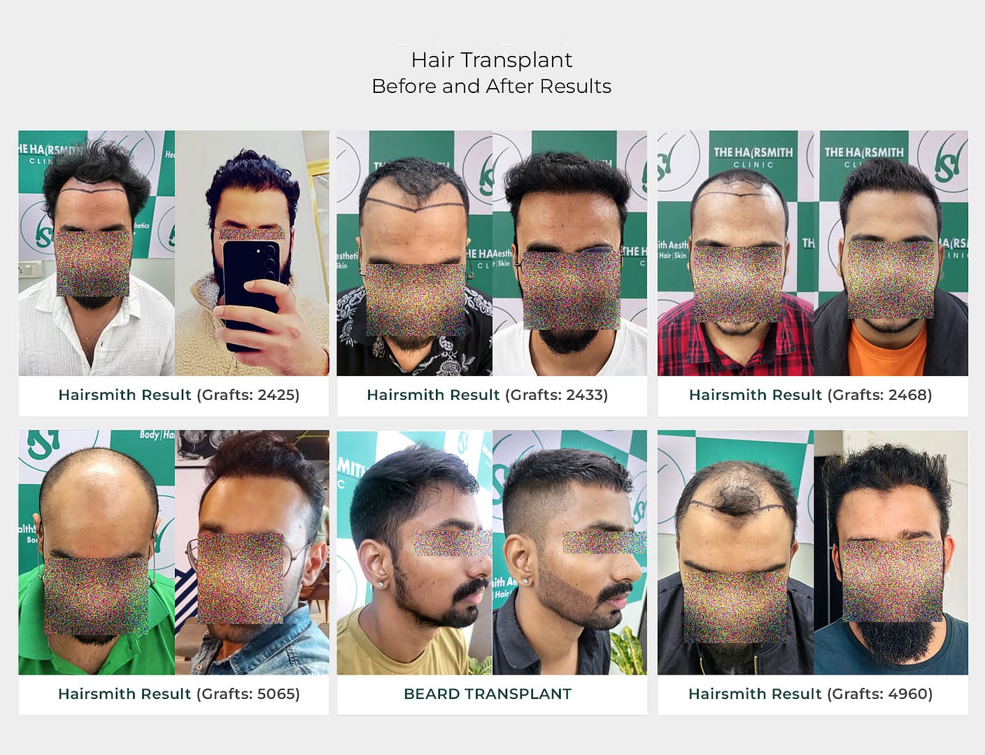 hair transplant and beard hair transplant