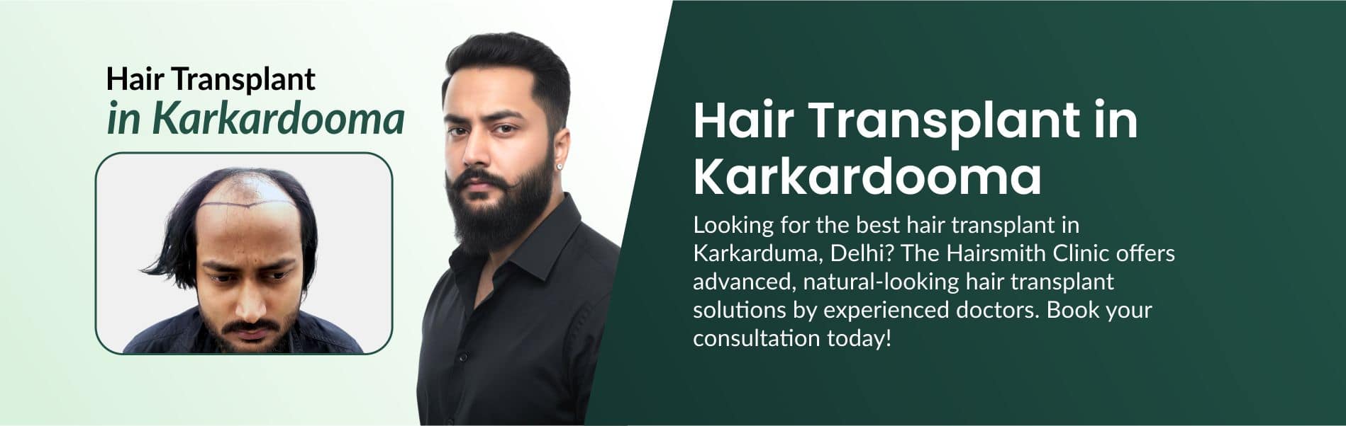 Hair Transplant Clinic in Karkardooma