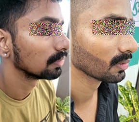 beard hair transplant