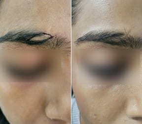 eyebrow hair transplant
