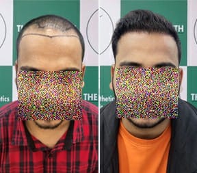 hair transplant
