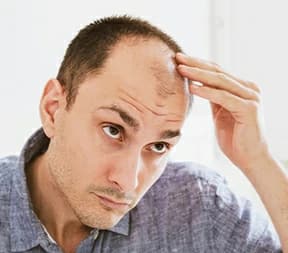 receding hairline hair transplant