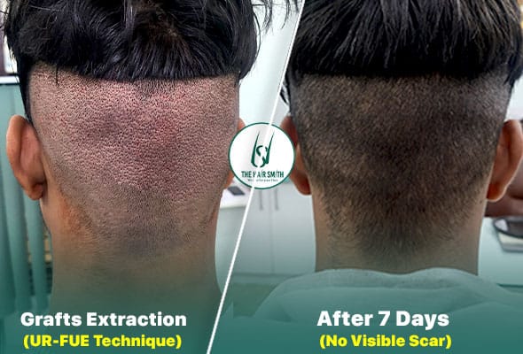 hair transplant