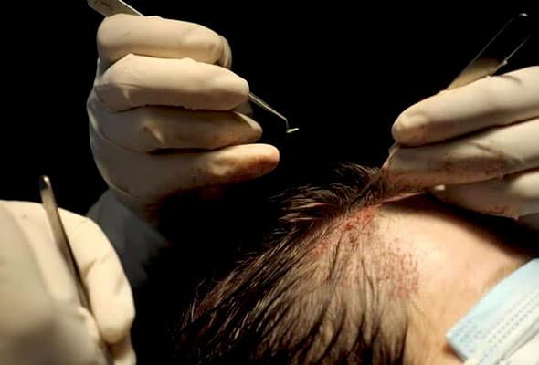 kanpur hair transplant