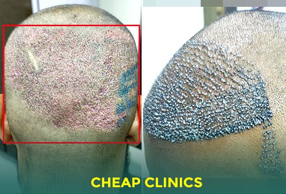 bad hair transplant hairline