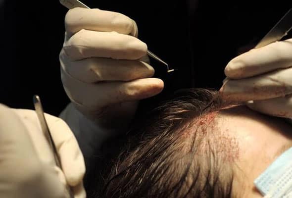 hair transplant hygiene standards