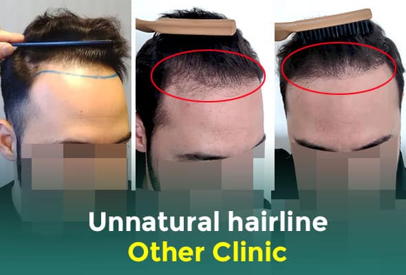 hair transplant hairline looks unnatural