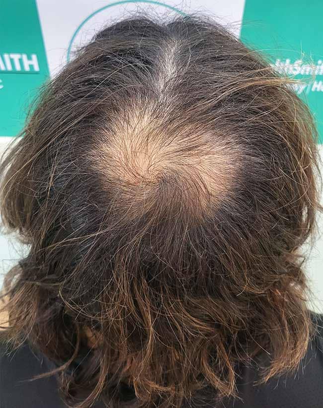 crown hair transplant india