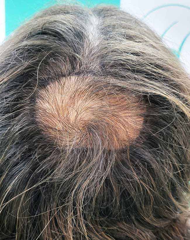 corwn hair transplant delhi