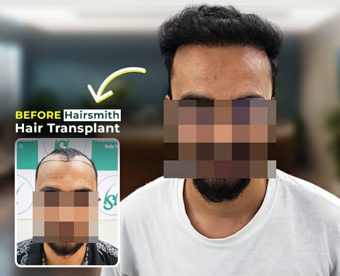 hair transplant