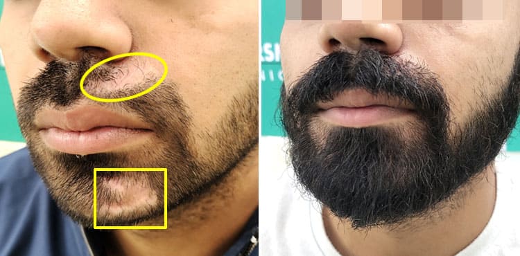 scar beard transplant