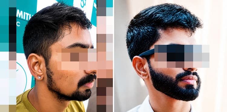 beard hair transplant cost