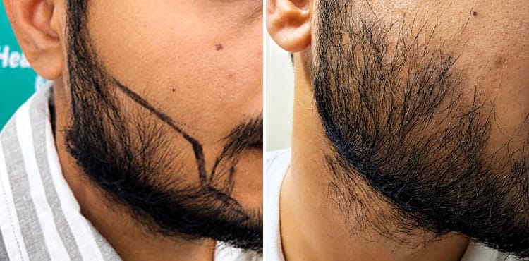 beard and hair transplant cost