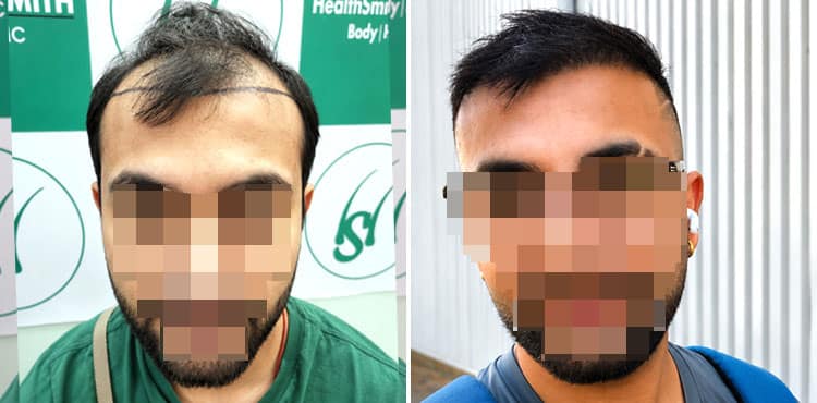 Hair transplant before and after result after 6 months using Advanced UR-FUE technique at The Hairsmith Clinic, Karkardooma, East Delhi, showing natural hairline restoration and improved density.