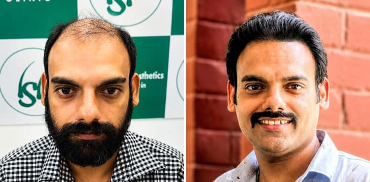 hair transplant result