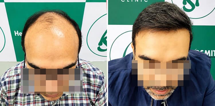 Before and after UR-FUE hair transplant result for advanced baldness (Norwood 6), showing natural hairline restoration and improved hair density at The Hairsmith Clinic in Delhi.