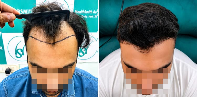Before and after FUE hair transplant result showing natural hairline restoration at The Hairsmith Clinic in Delhi.