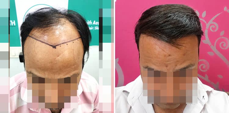 hair transplant result
