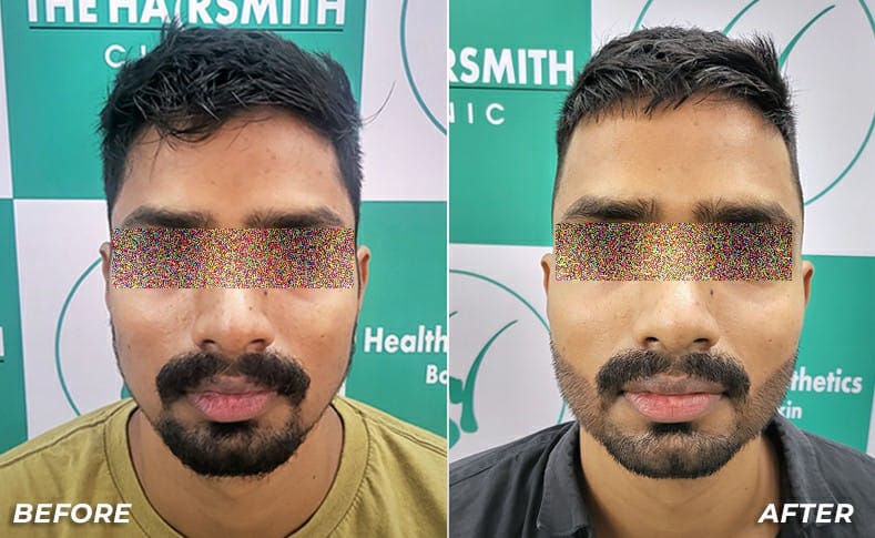 beard hair transplant