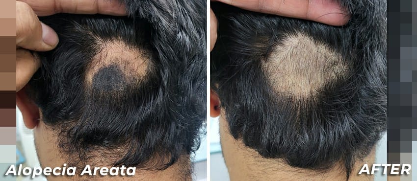 alopecia areata result