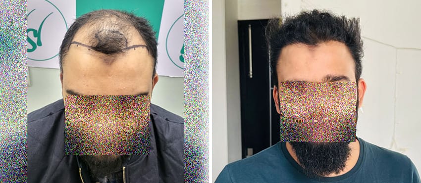 Hair Transplant Result