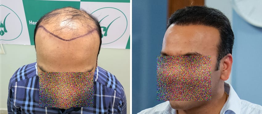 Hair Transplant Result