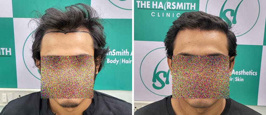 Hair Transplant Result