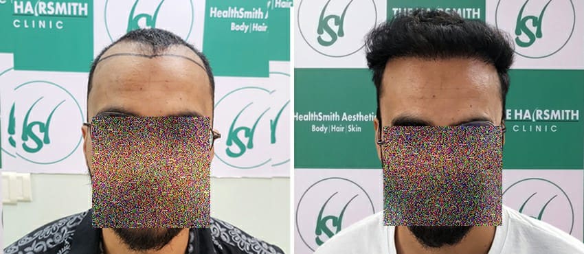 Hair Transplant Result