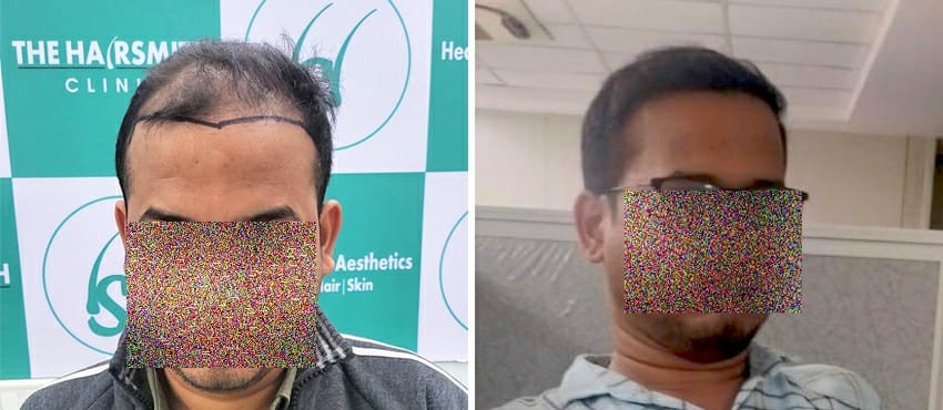 Hair Transplant Results
