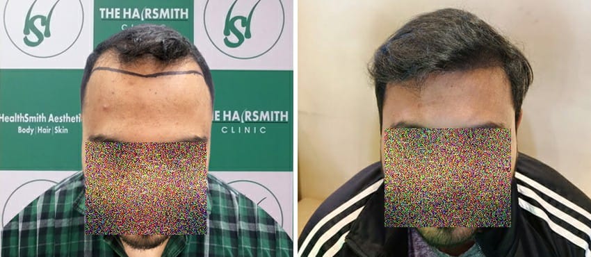 Hair Transplant Result