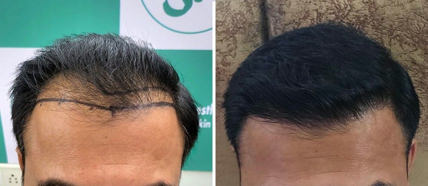 best hair transplant result