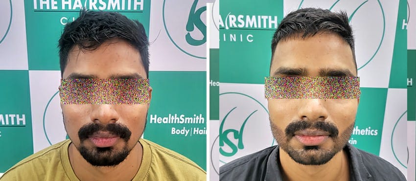 beard hair transplant before after