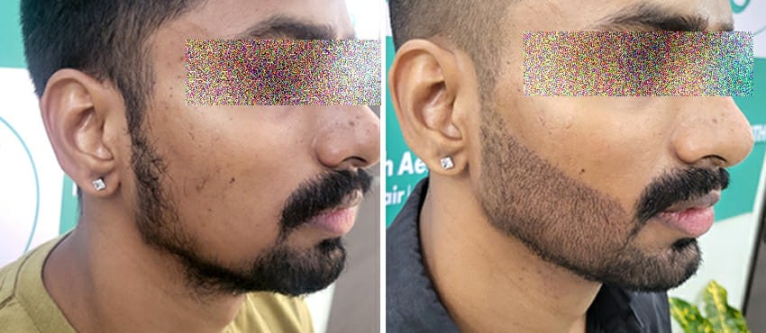 beard hair transplant