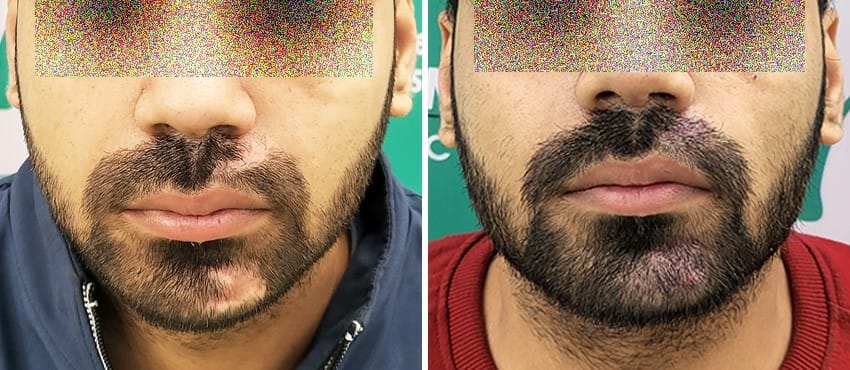 beard hair transplant in delhi