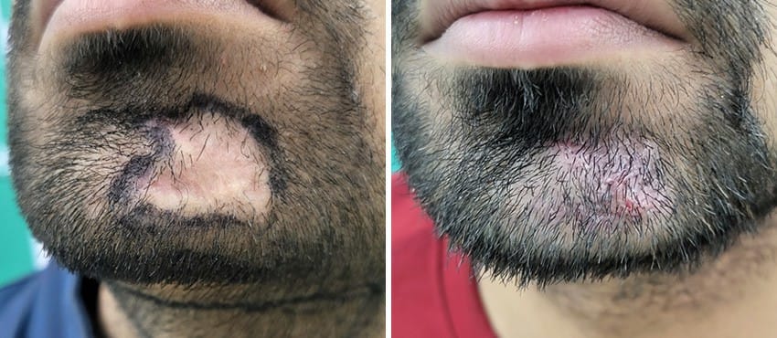 beard hair transplant in delhi