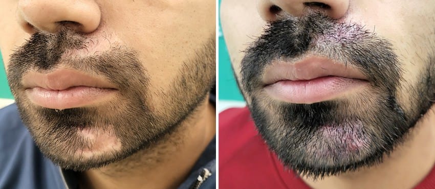 beard hair transplant in delhi