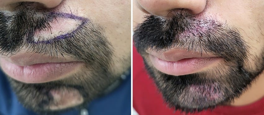 beard transplant result