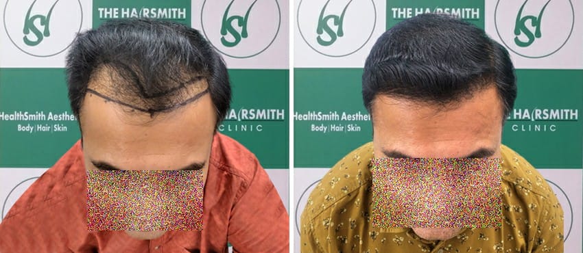 hair transplant in delhi