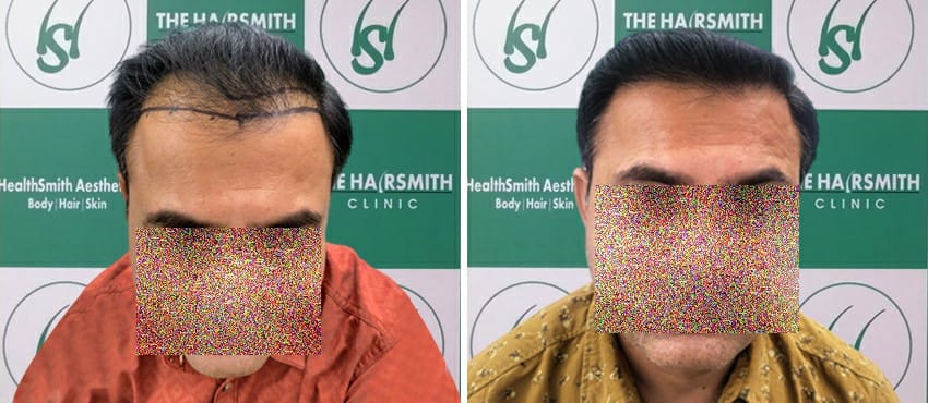 hair transplant in delhi