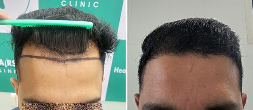 Hair Transplant Result