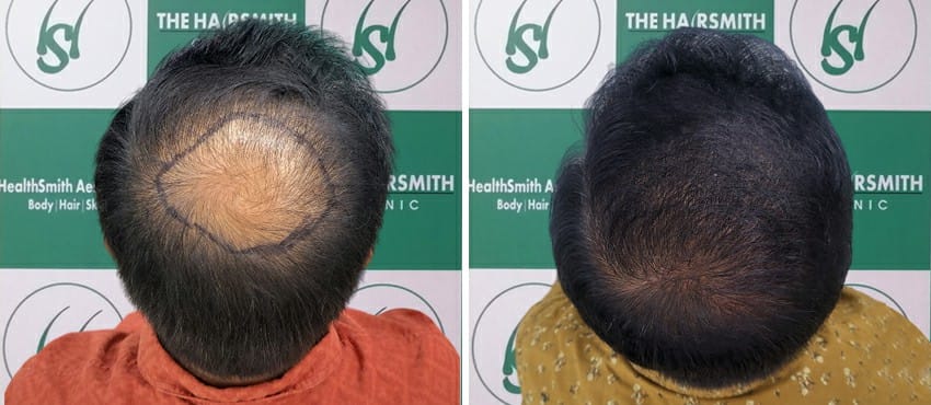 hair transplant in delhi
