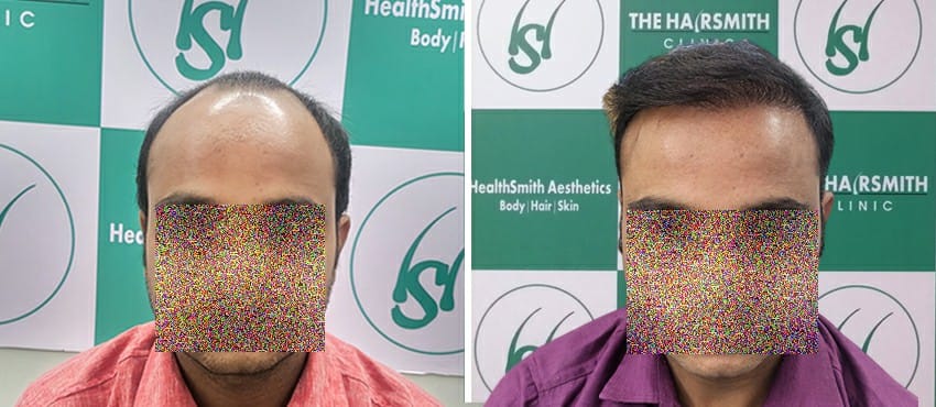 Hair Transplant Result