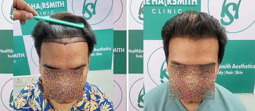 Hair Transplant Result