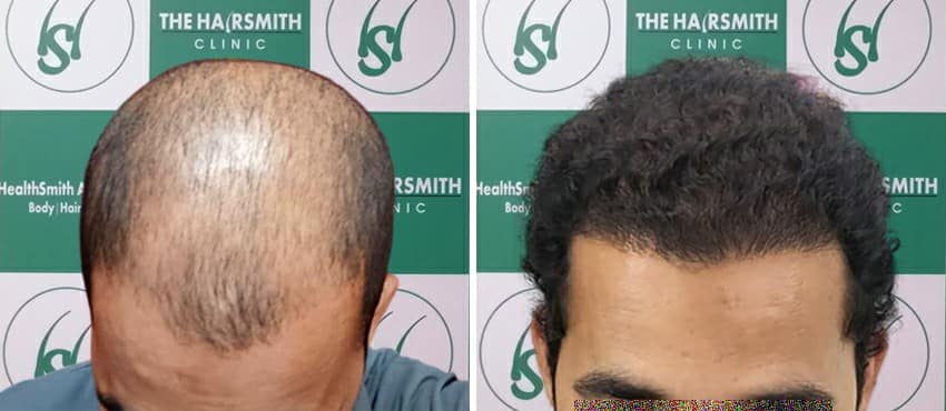 Hair Transplant Result