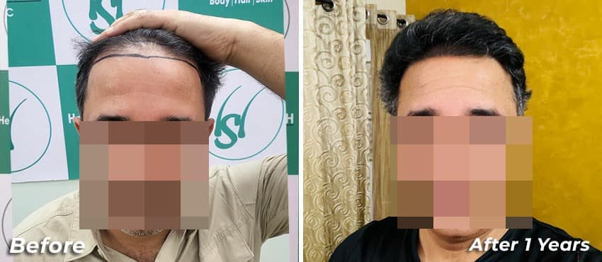 hair transplant in delhi