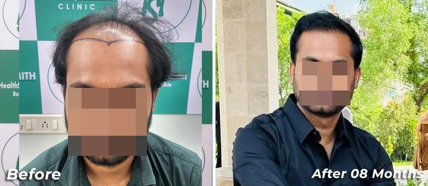 Hair Transplant Before and after