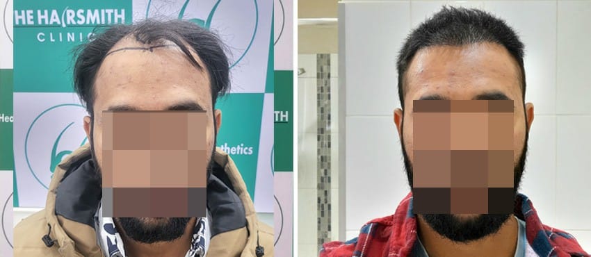 before after hair transplant results