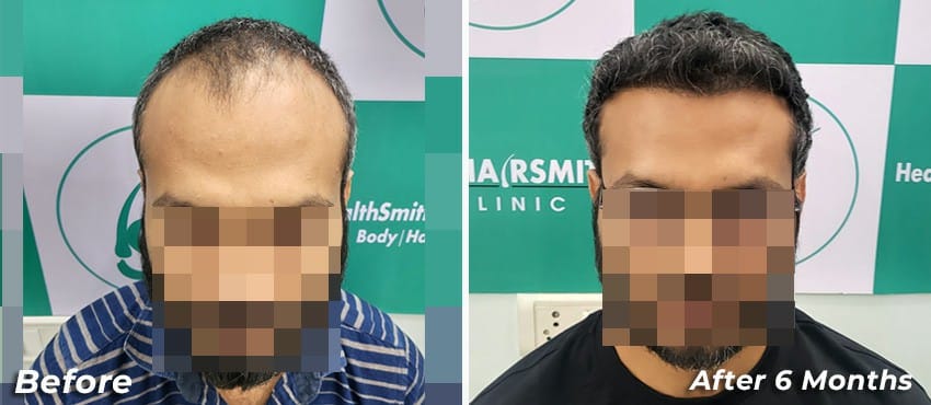 best hair transplant results