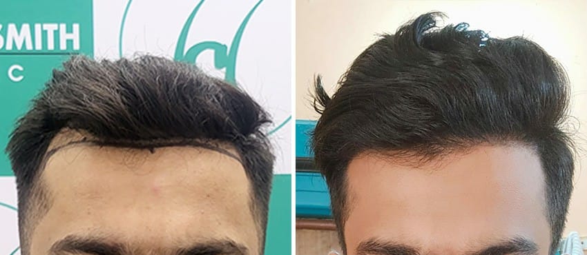 before after hair transplant result