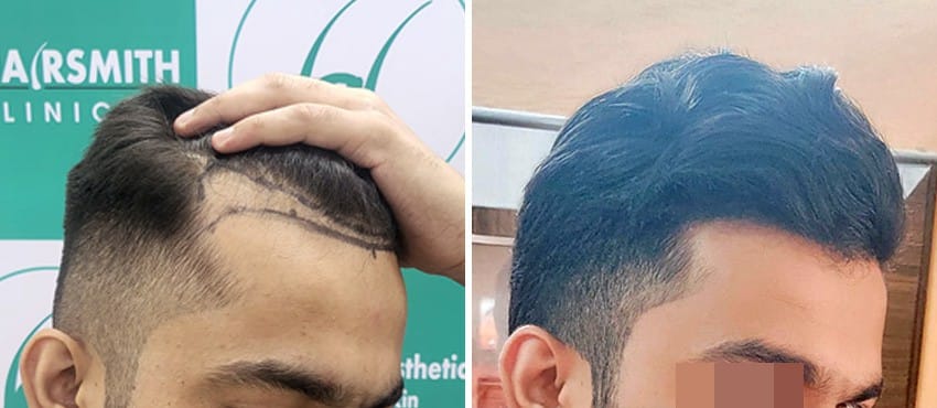 before after hair transplant results